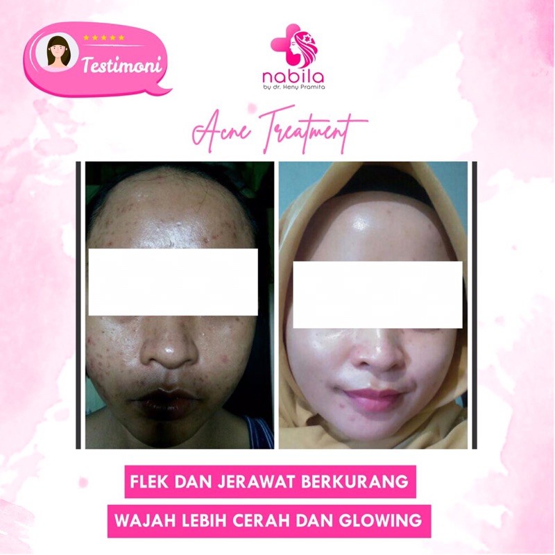 NIGHT CREAM ACNE SERIES | KRIM MALAM | NABILA | NABILA SKINCARE | SKINCARE NABILA