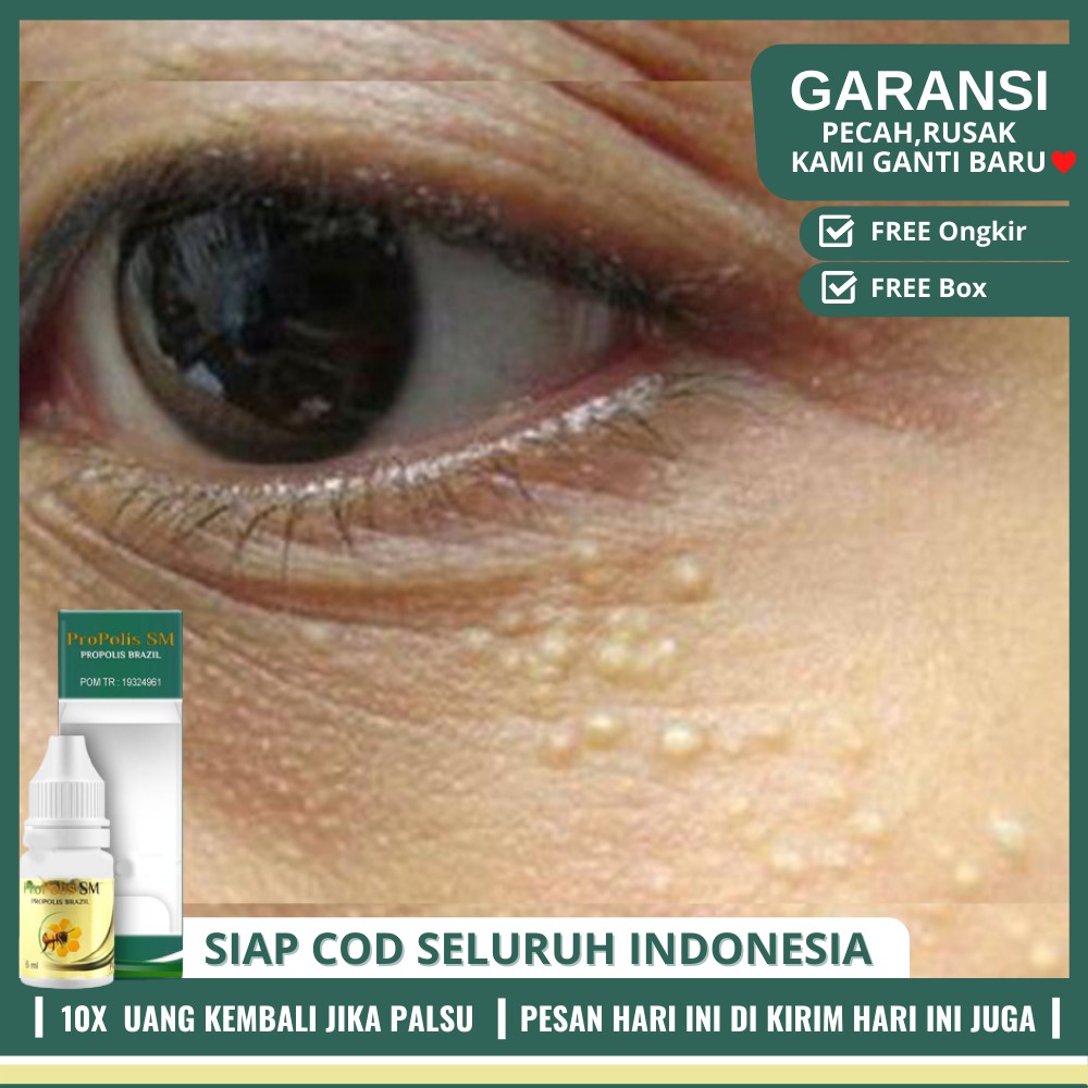 Obat Penghilang Milia Di Wajah - Menghilangkan Milia - Propolis SM