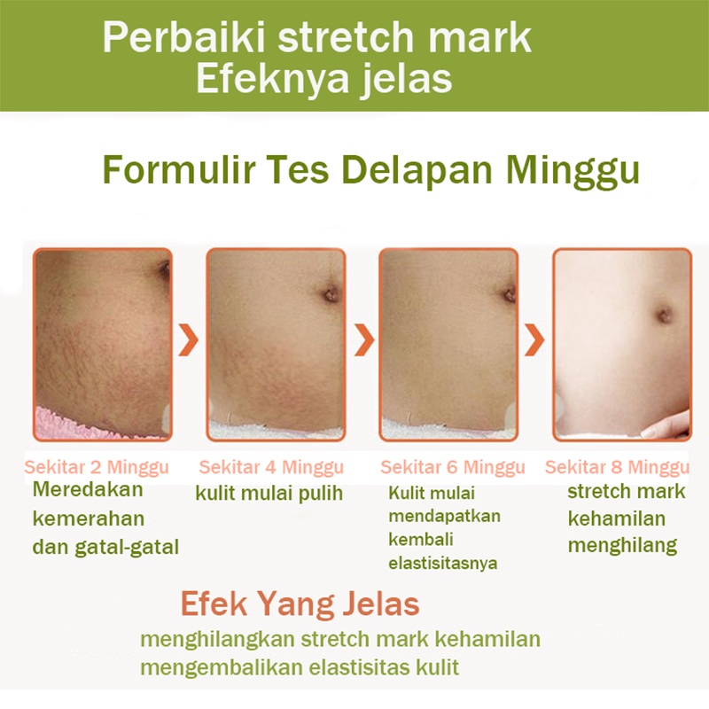 Stretch Mark Cream Mama Choice Stretch Mark 30ml  Stretch Mark Dan Obesity Mark Krim Mengencangkan Perut Stretch Mark Removal Cream Krim Perawatan Postpartum