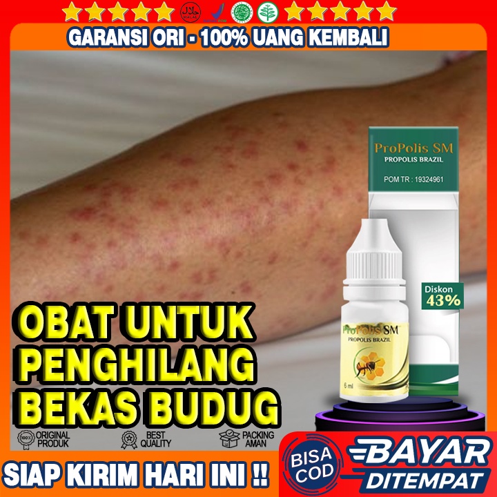 Obat Penghilang Bekas Budug Di Kaki Tangan Badan, Obat Kudis, Gatal Gatal, Kulit Borok, Obat Scabies