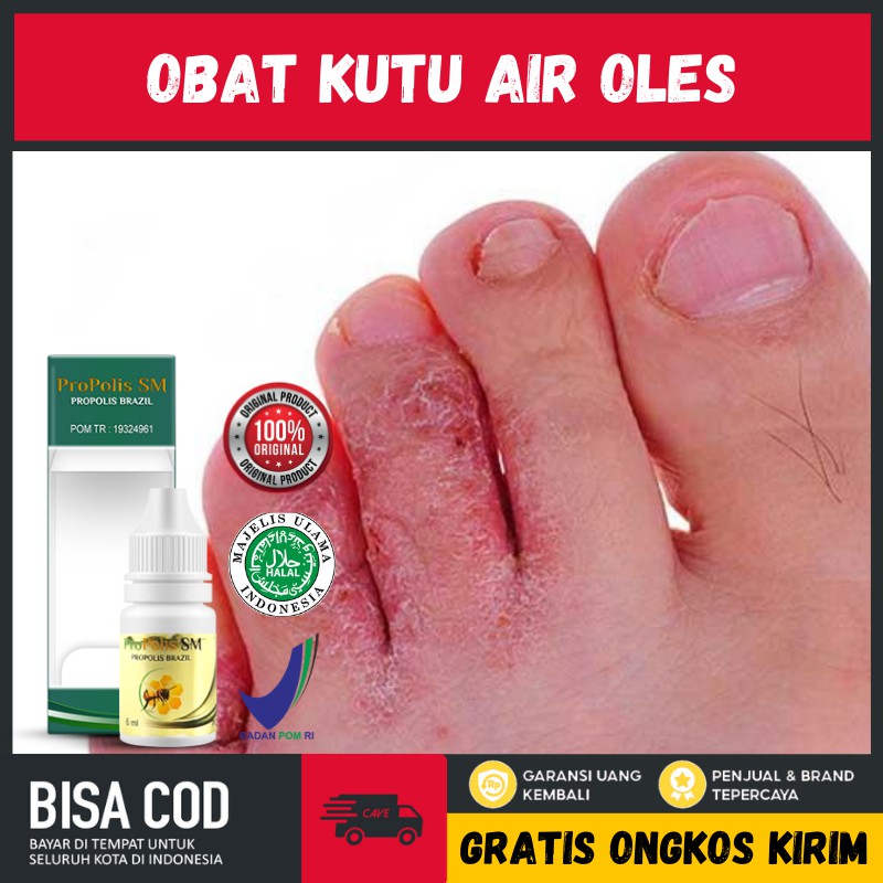 Obat Tangan Kaki Bengkak Luka Pecah Pecah Iritasi Karena Kutu Air Kurap Jamur Kadas Kutu Air di Kaki