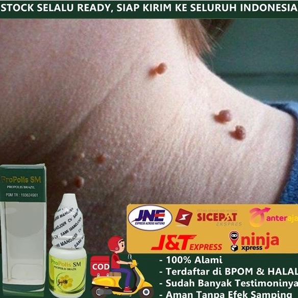 

Sale Obat Herbal Penghilang Kutil, Papiloma, Skin Tag, Di Wajah Leher Tubuh /OBAT HERBAL ASAM URAT/OBAT HERBAL PELANGSING/OBAT HERBAL KOLESTEROL/OBAT HERBAL DIABETES