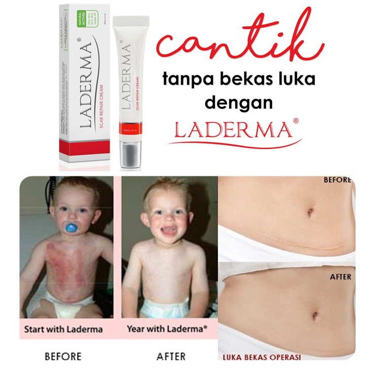 Laderma Scar Repair Cream PENGHILANG BEKAS LUKA DAN BEKAS JERAWAT 8ml READY MOM exp agt 2024