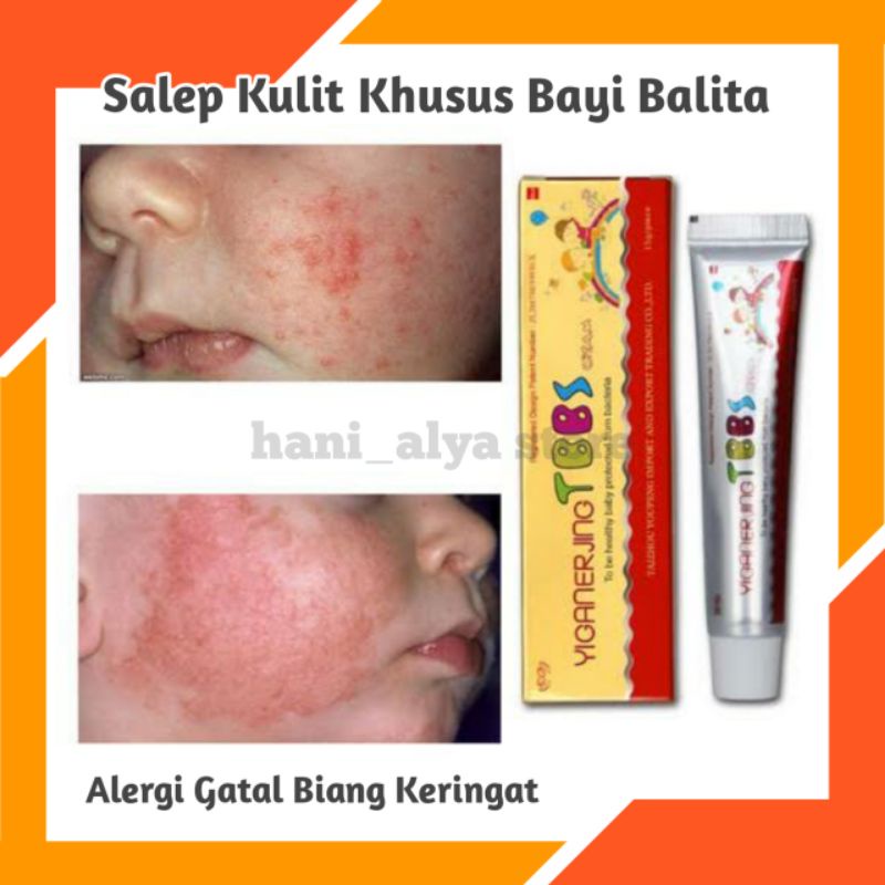 Salep Gatal bayi baby anak alergi eksim ruam kulit yiganerjing tbbs 15gr