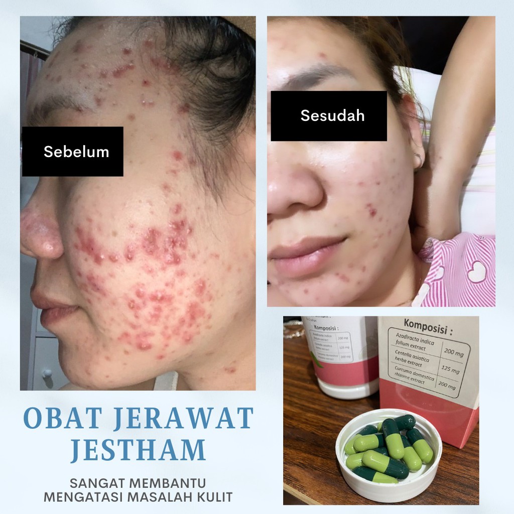 ASLI This Capsule for Skin isi 30butir Kapsul Pemutih dan Pencerah Wajah / Obat Jerawat Jestham