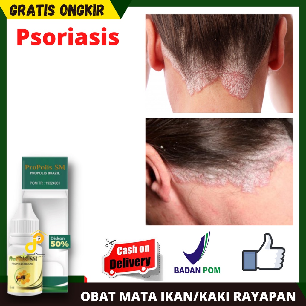 Obat Kepala Psoriasis - Obat Penyakit Kulit Psoriasis - Obat Psoriasis Kepala - Obat Gatal Psoriasis