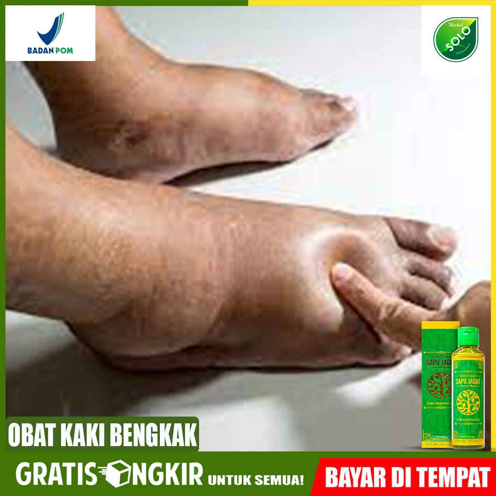 Jual Obat Herbal Kaki Bengkak Obat Kaki Kembung Obat Jari Tangan