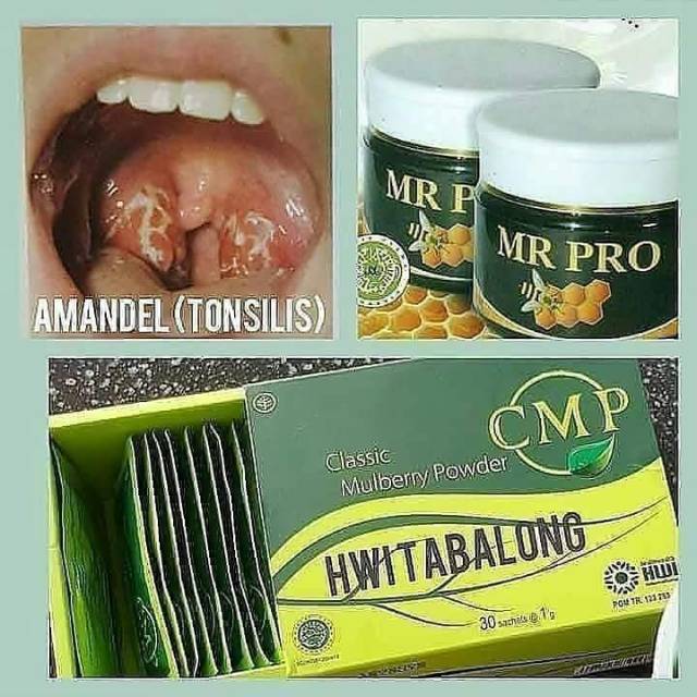 Mr pro dan CMP herbal alami untuk mengatasi amandel