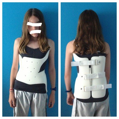 Muenster Scoliosis Orthosis / MSO Brace / Scoliosis Brace / Postur / Koreksi Skoliosis / Ortopedi