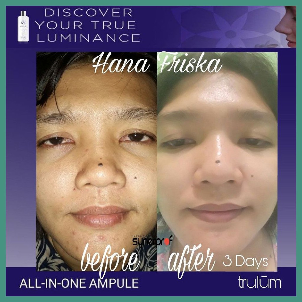 Krim Jerawat & Pemutih Wajah Cepat Ampuh Trulum Skincare Anti Aging
