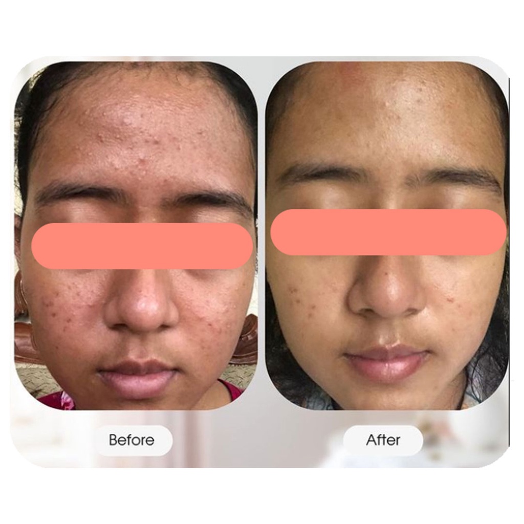 ADLEEVA BY ADEEVA Paket Complete Acne Bright Series Skincare Original Anti Jerawat BPOM-2