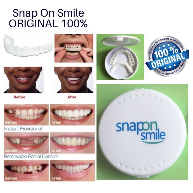 Snap On Smile/ Gigi palsu Snap On 1 set
