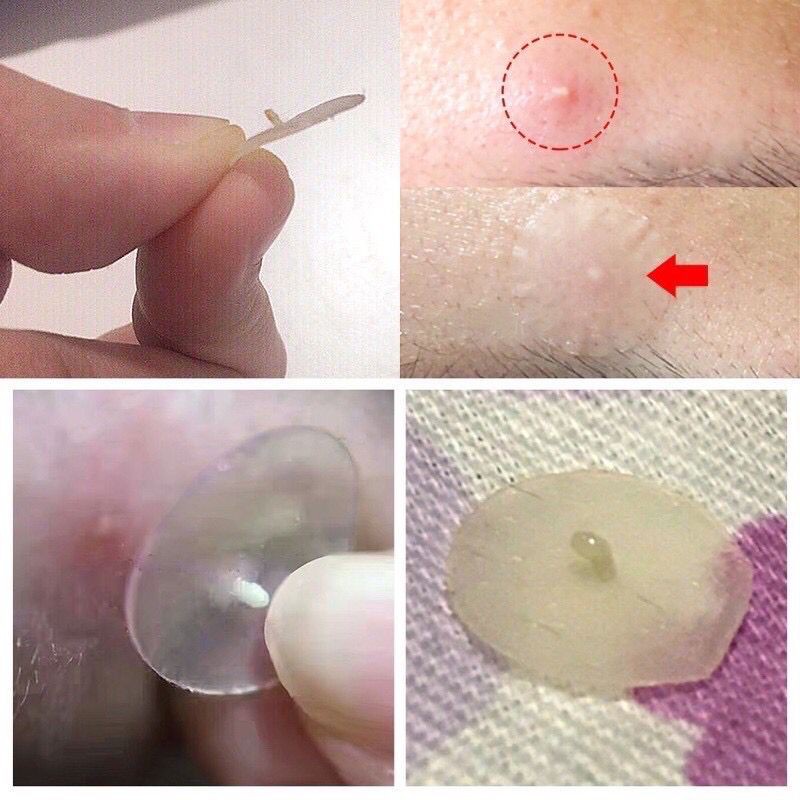 Acne Patch Pimple Blemish Removal Stickers Breathable Pimple Blemish Removal Sticker Facial Care 36 patches Acne Pimple