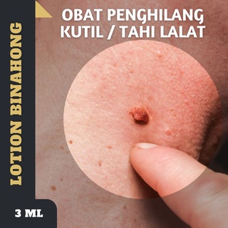 SALEP KUTIL / OBAT PENGHILANG KUTIL / OBAT PENGHILANG MATA IKAN / OBAT KUTIL AMPUH / LOTION BINAHONG