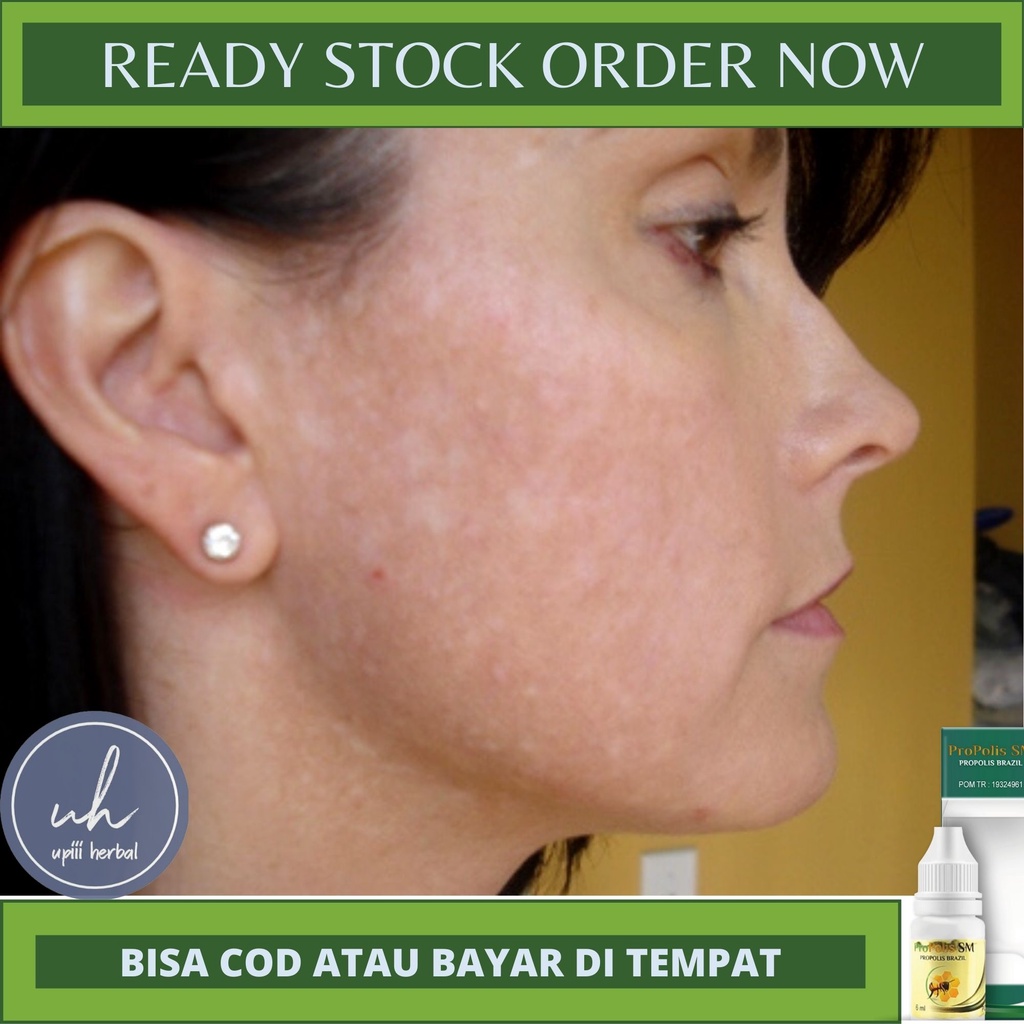 OBAT BALAS BOGO, OBAT UNTUK PENGHILANG BALAS BOGO, OBAT PENGHILANG BERCAK PUTIH DI WAJAH, OBAT PANU,