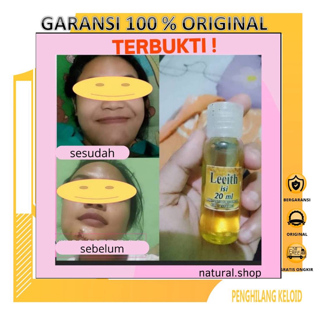 Minyak Obat Penghilang Keloid Yang Sudah Lama Luka Bakar Bagus Scar Krim Keloid Salep Serum Obat Pen