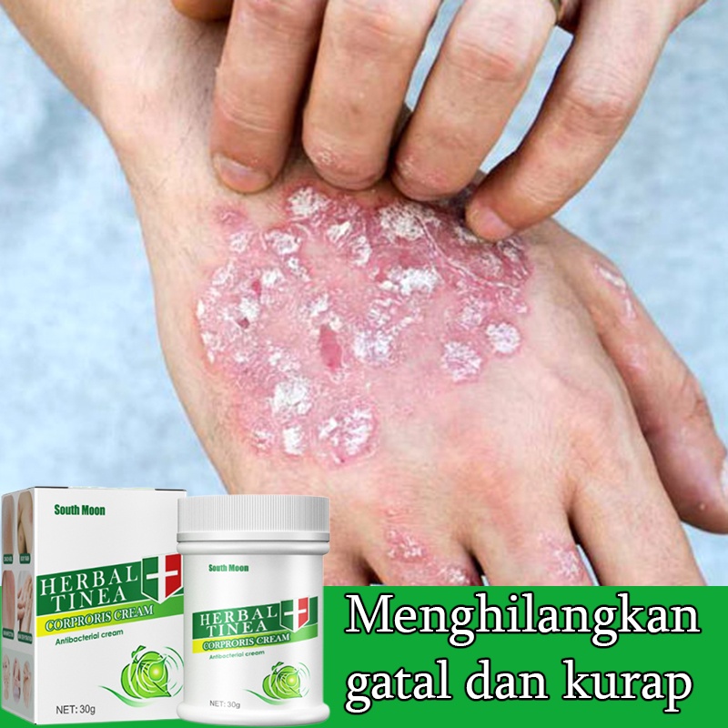 Jual Salep gatal Salep Eksim Salep kulit Krim psoriasis paling ampuh