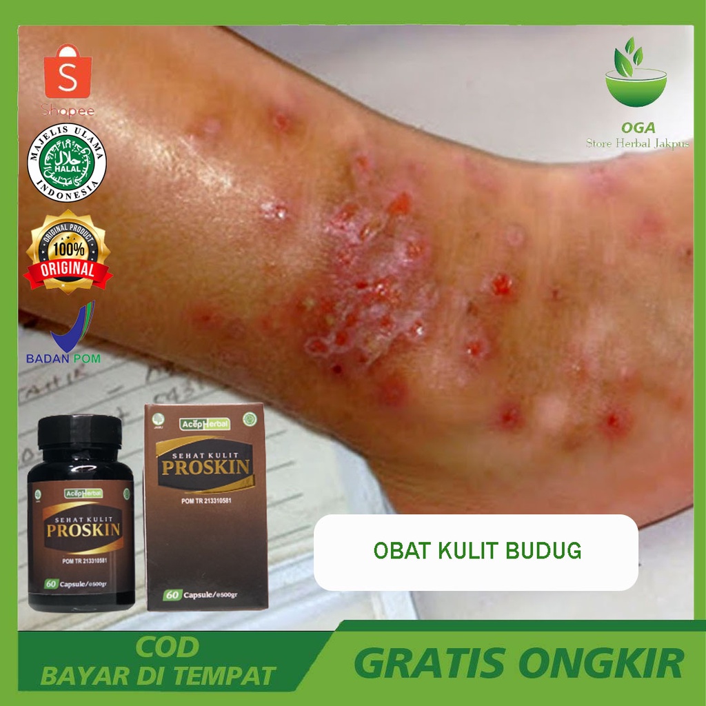Obat Gatal Kulit Budug | Obat Gatal Kulit Bruntusan | Obat Gatal Kulit Cenang | Obat Gatal Kulit Cac