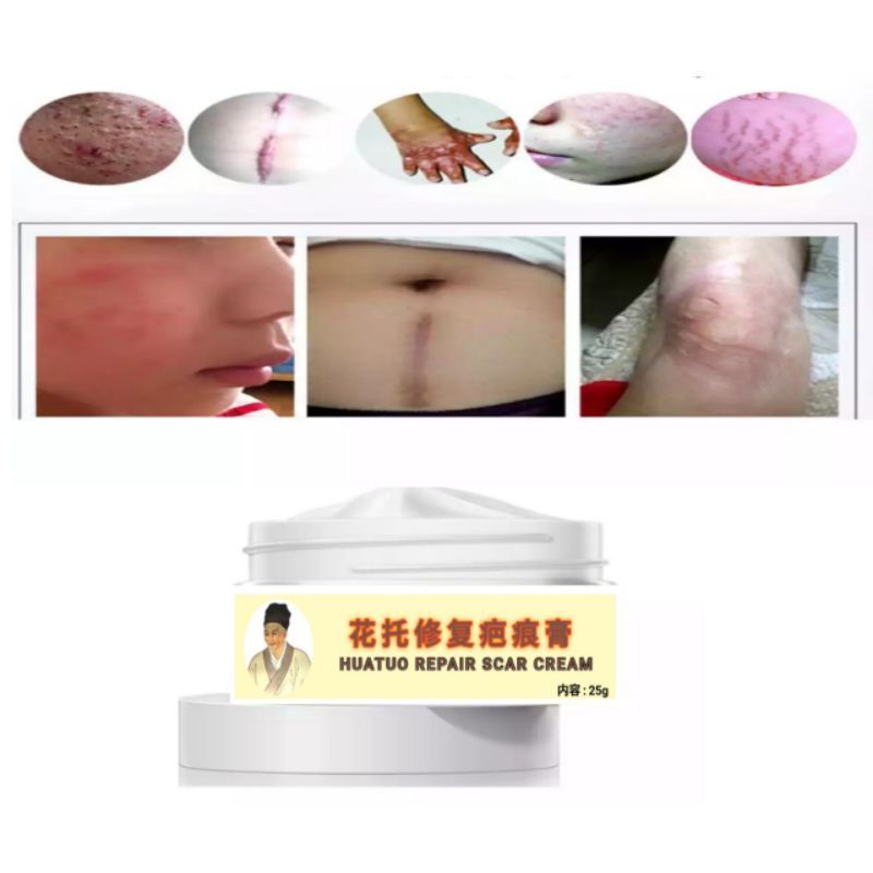 salep penghilang bekas luka keloid huatuo