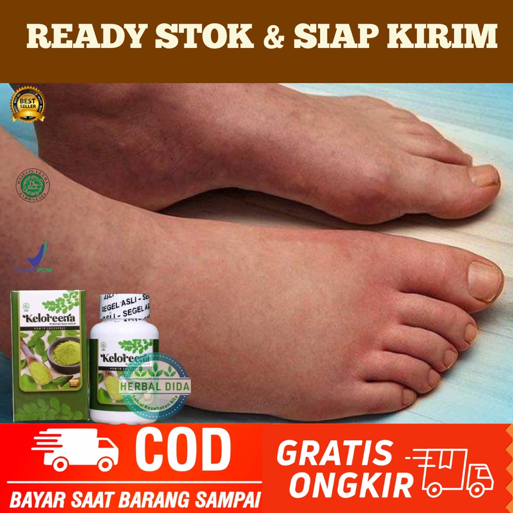 KELOREENA 100% ORIGINAL BPOM, Obat Kaki Bengkak Asam Urat, Obat Bengkak Pada Kaki, Obat Kaki Bengkak