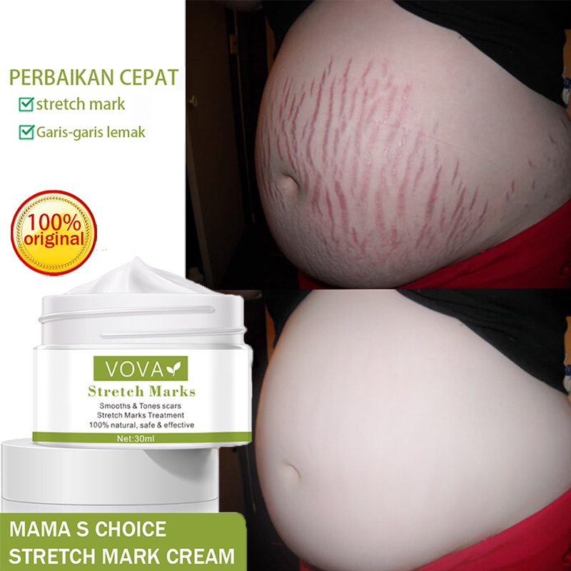 Stretch Mark Cream Mama Choice Stretch Mark 30ml  Stretch Mark Dan Obesity Mark Krim Mengencangkan Perut Stretch Mark Removal Cream Krim Perawatan Postpartum