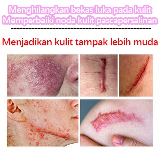 Stretchmark Stretch mark cream Krim stretch mark krim penghilang bekas luka 60ML Secara efektif menghilangkan stretch mark Menghilangkan stretch mark dengan cepat dalam seminggu Memudarkan bekas luka Onset cepat Tersedia untuk ibu hamil