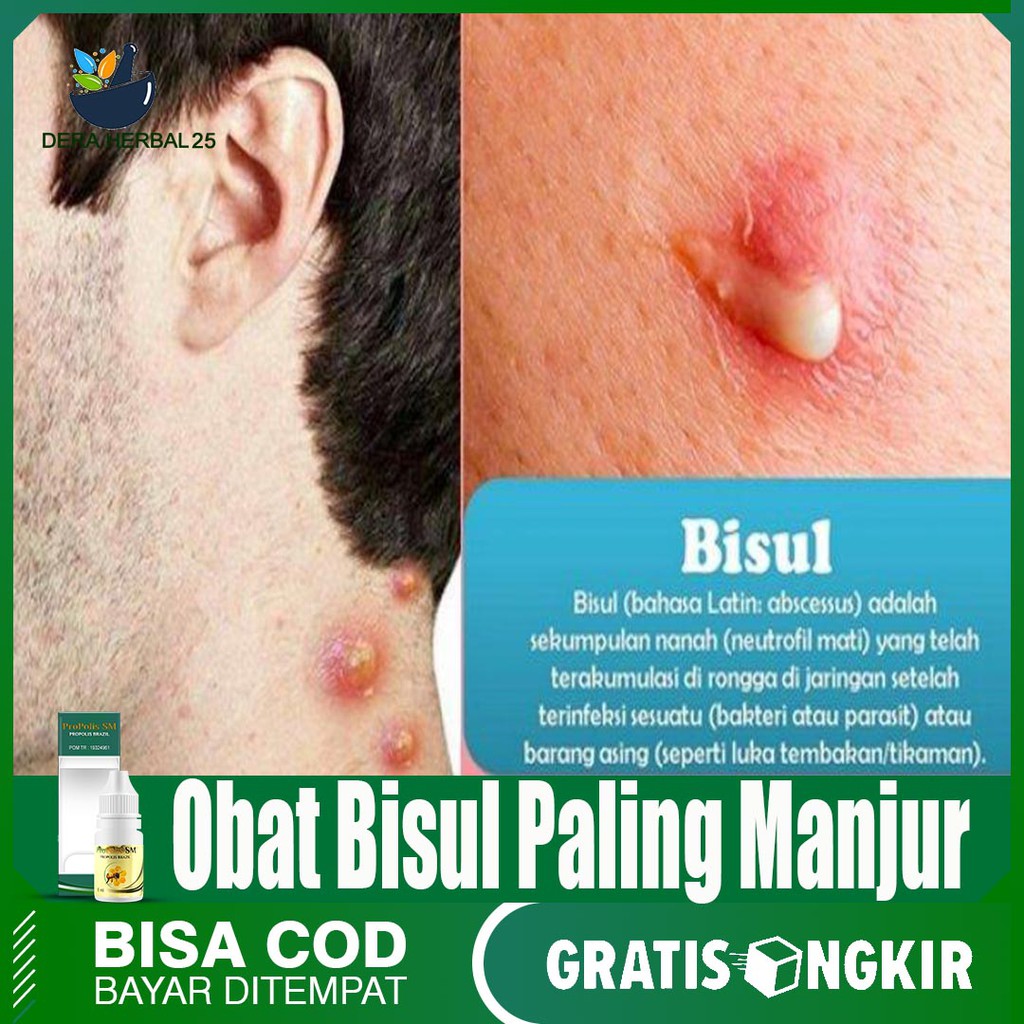 Propolis Sm Obat Herbal Untuk Atasi Bisul Di Leher Di Pundak Di Lengan Di Tubuh Di Muka Bisa Cod Shopee Indonesia