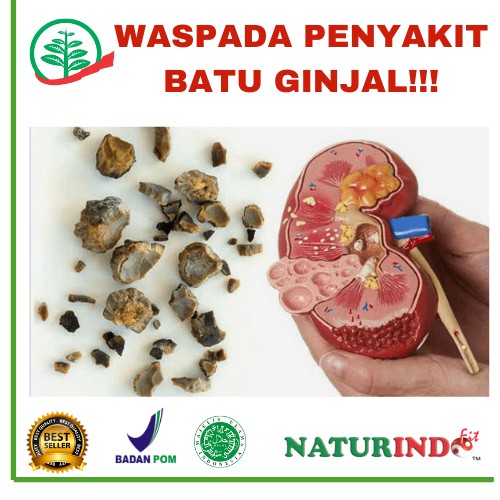 Obat herbal untuk batu ginjal // URINOFIT
