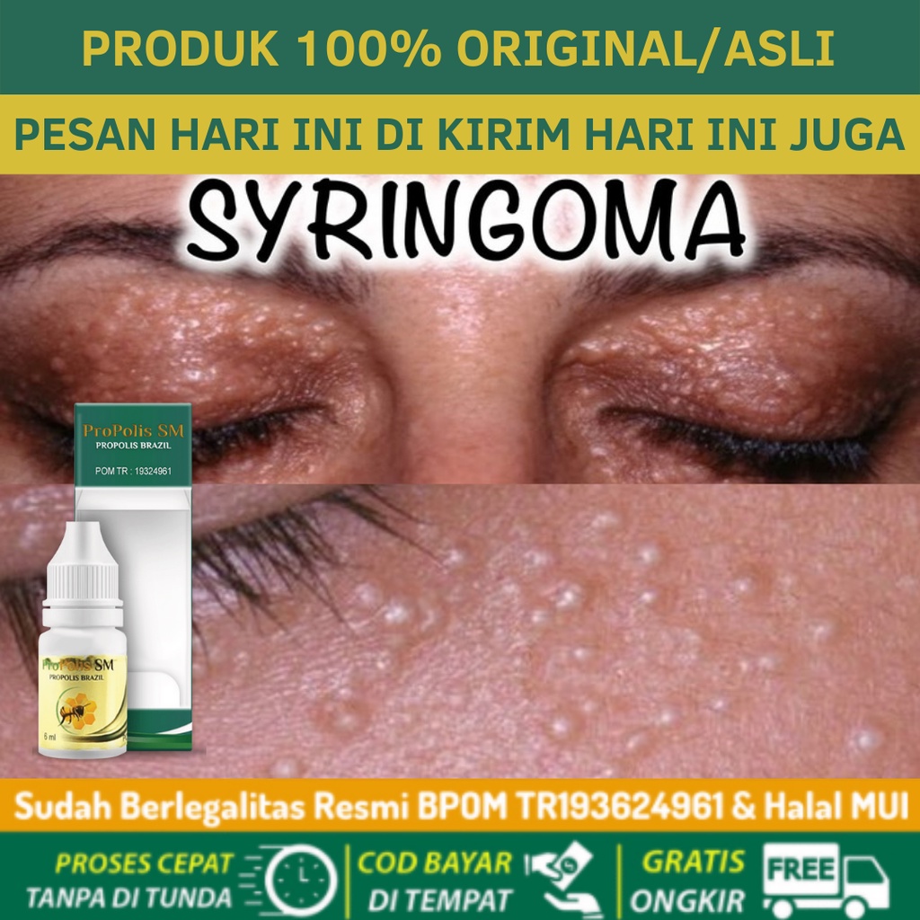 Jual Obat Penghilang Syringoma, Obat Xanthelasma, Gumpalan Lemak Di ...