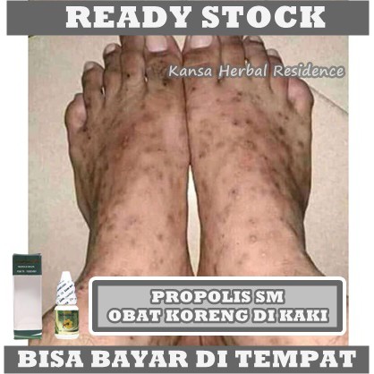 Obat Koreng, Penghilang Koreng di Kaki, Koreng Gatal, Koreng Bernanah, Bekas Koreng di Tangan, Luka Koreng, Salep Korengan di Seluruh Badan, Koreng di Kepala, Borok, Bopeng, Bekas Jerawat, Budug, Menghilangkan Bekas Luka Dengan ProPolis SM