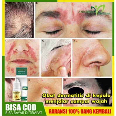 Obat Dermatitis di Kepala Menjalar Sampai Wajah | Herbal Penghilang Dermatitis Kontak Alergi, Dermat