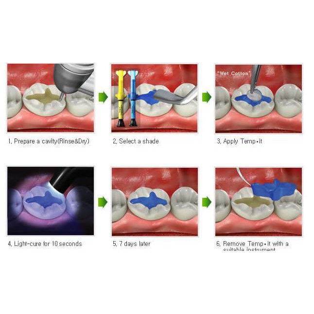 DENTAL TEMPORARY FILLING TAMBALAN SEMENTARA LIGHT CURE SYSTEMP INLAY ONLAY