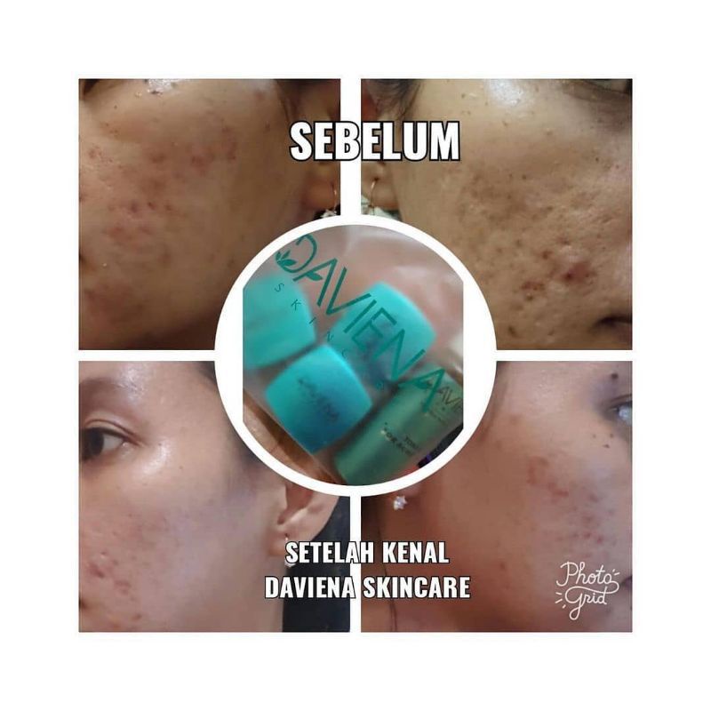 Daviena Skincare Paket Acne Series Davienaskincareofficial Davina Devina Lampung Surabaya Jakarta Jerawat Pencerah Pemutih Wajah Glowing Bpom Daviena Skincare-3