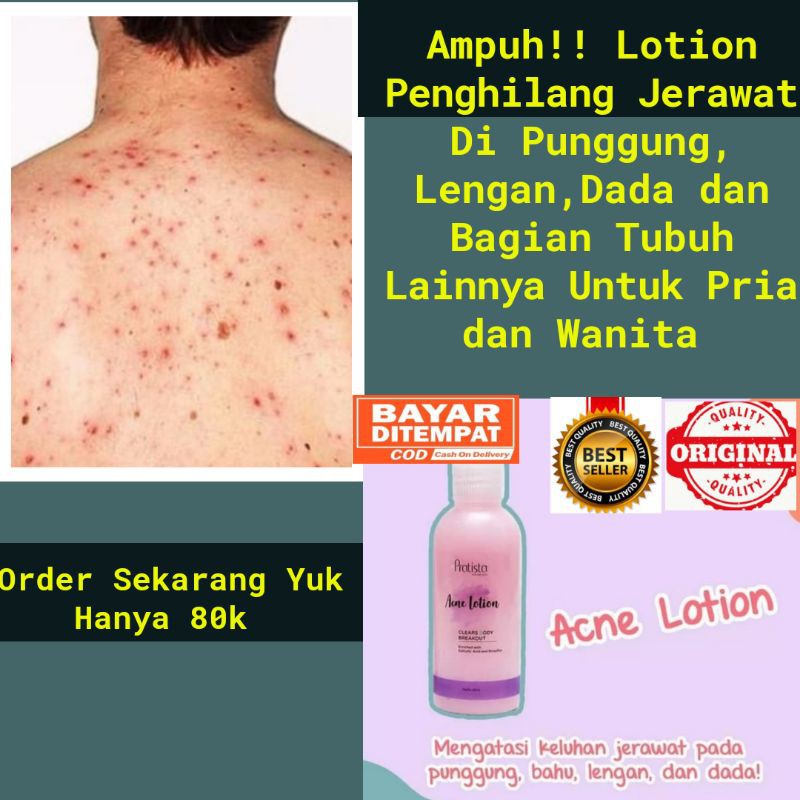 Jual Obat Jerawat Punggung / Badan / Dada / Wajah Acne Lotion Body