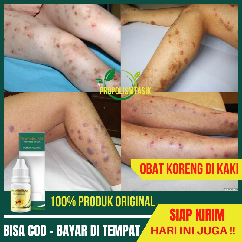 Obat Koreng, Penghilang Koreng di Kaki, Bekas Koreng di Tangan, Salep Korengan di Seluruh Badan 100%