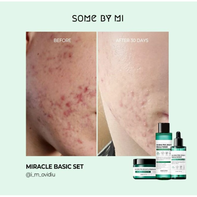 Image of SOMEBYMI Some By Mi 30 days Miracle Toner AHA-BHA-PHA 150ml Obat Jerawat Ampuh #6