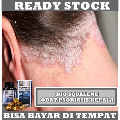 Obat Ketombe Berkerak - Obat Koreng Di Kepala - Obat Kulit Kepala Berkerak / Bersisik - Obat Kulit Kepala Kering Mengelupas - Obat Psoriasis Kepala - Obat Dermatitis Seboroik - Obat Tinea kapitis - Obat Ketombe Parah