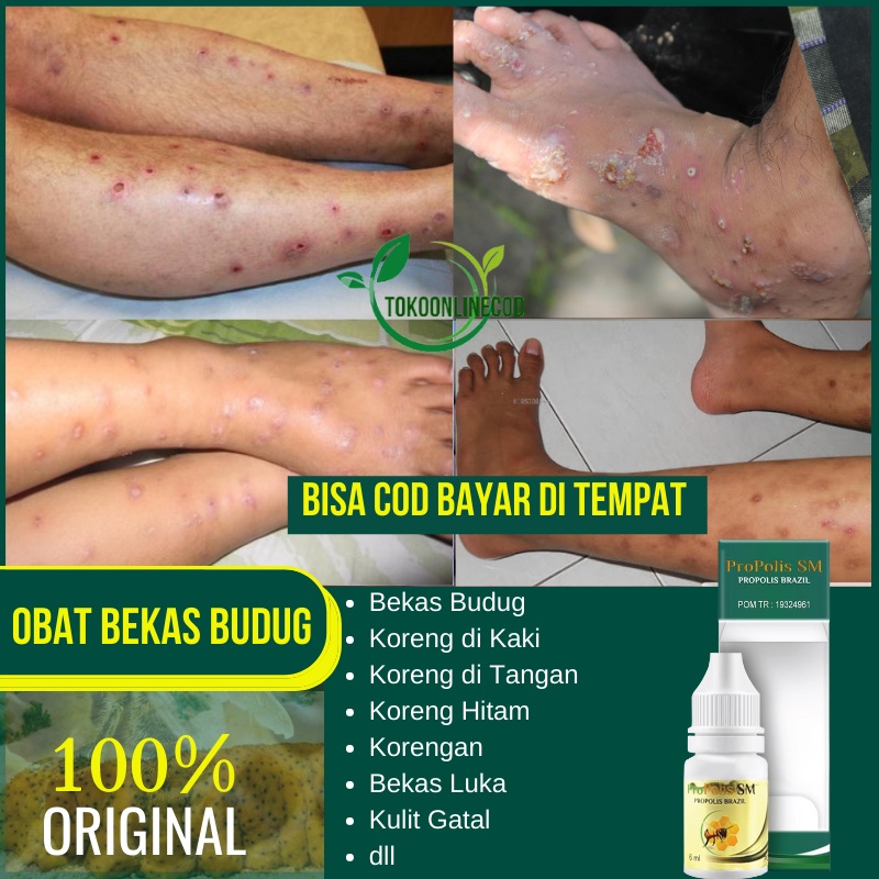 Jual Obat Penghilang Bekas Budug Koreng Di Kaki Bekas Luka Lama Korengan Gudik Gudig