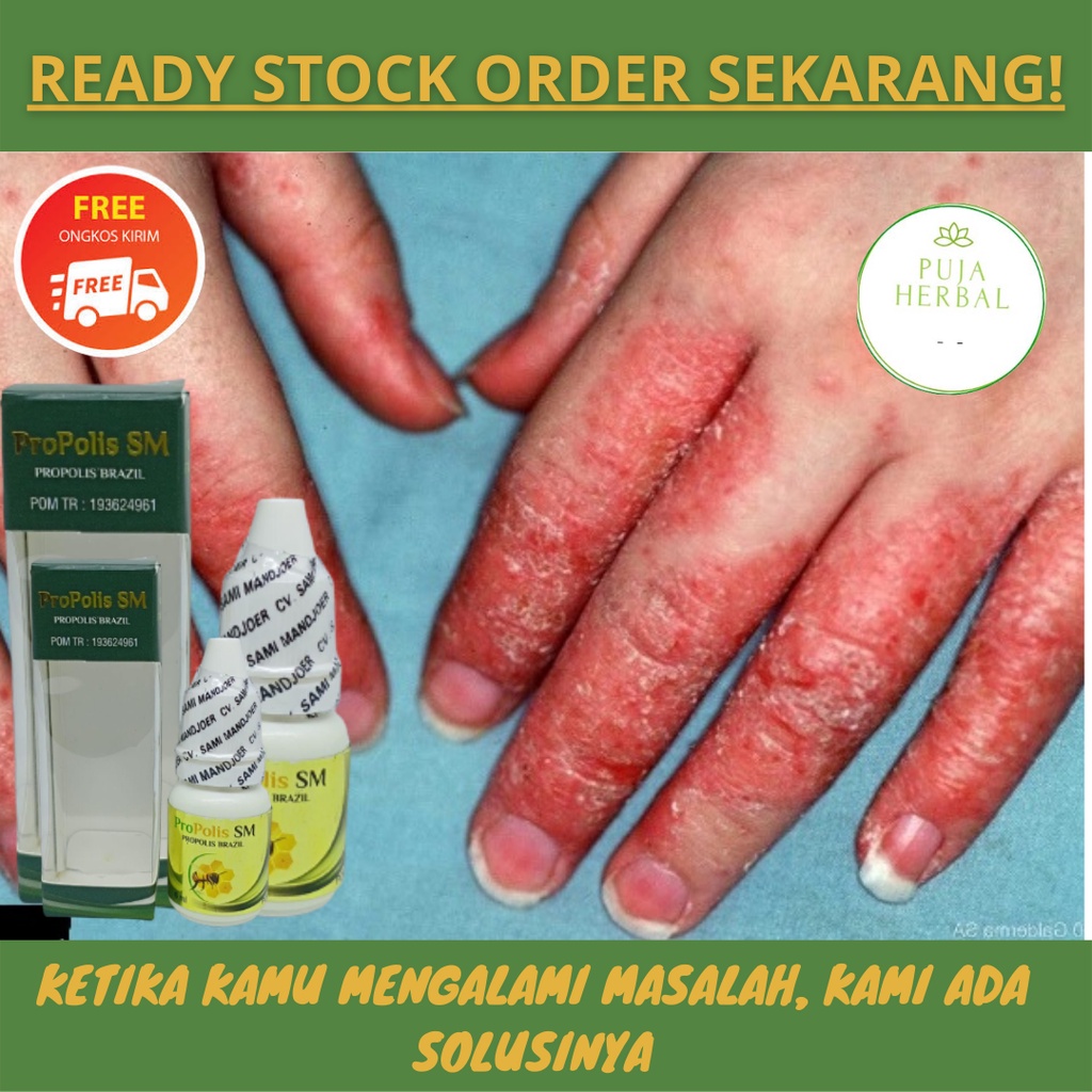 Salep Kutu Air, Obat Oles Kutu Air, Penghilang Kutu Air, Obat Kutu Air Di Tangan, Obat Kutu Air Kaki