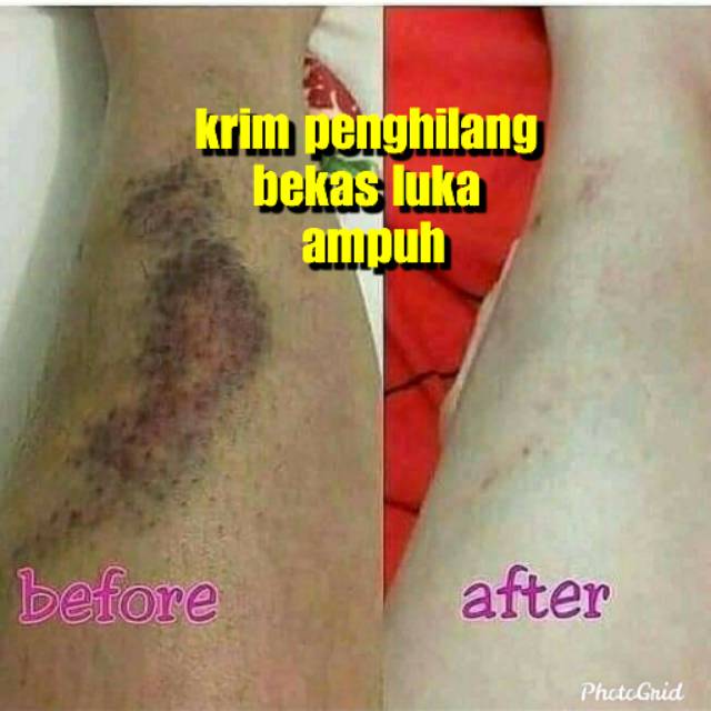 KRIM PENGHILANG BEKAS LUKA , BEKAS KORENG , BEKAS LUKA JAHITAN