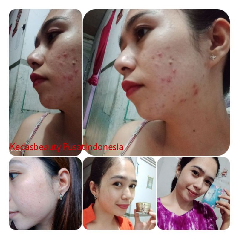 Sabun Kedas Beauty Original BPOM Sepaket Gold Jelly Kedas Beauty Pemutih Wajah Murah Cod-5