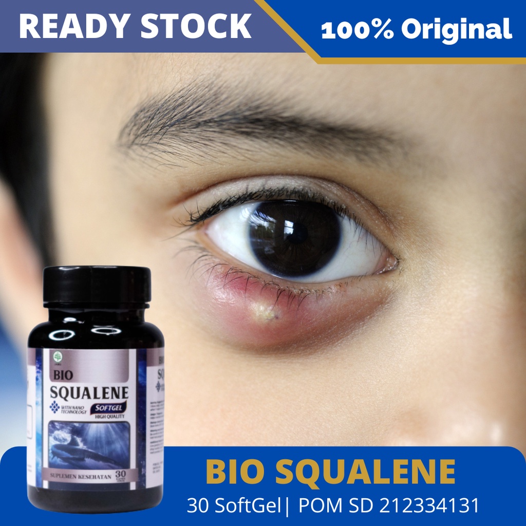 Obat Penghilang Benjolan di Kelopak Mata - Obat Mata Bintitan, Obat Mata Bintitan, Atasi Mata Bintitan, Obat Kalazion, Obat Untuk Mata Bintitan, Obat Benjolan Di Kelopak Mata, Salep Kalazion Bisa Diatasi Dgn Herbal Bio Squalene 100% Original