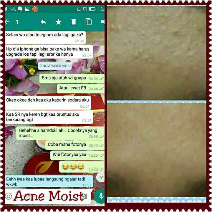 Acne Moist SR12 Cream Penghilang Jerawat BPOM Menjaga Kelembaban dan Melindungi Kulit dari Sinar UV