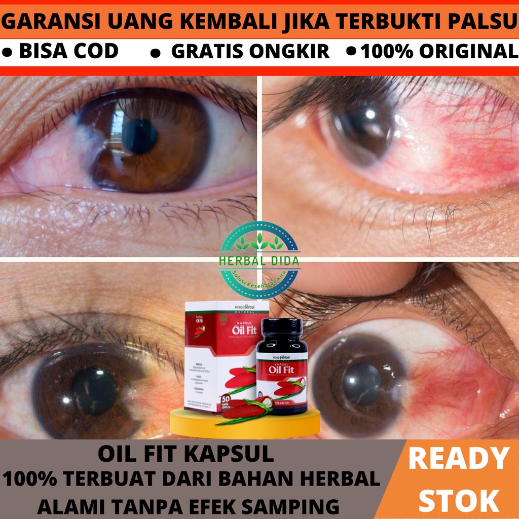 Obat Ulkus Kornea, Menghilangkan Titik Putih Di Mata, Luka Pada Mata, Obat Tukak Ulkus Kornea Pengli