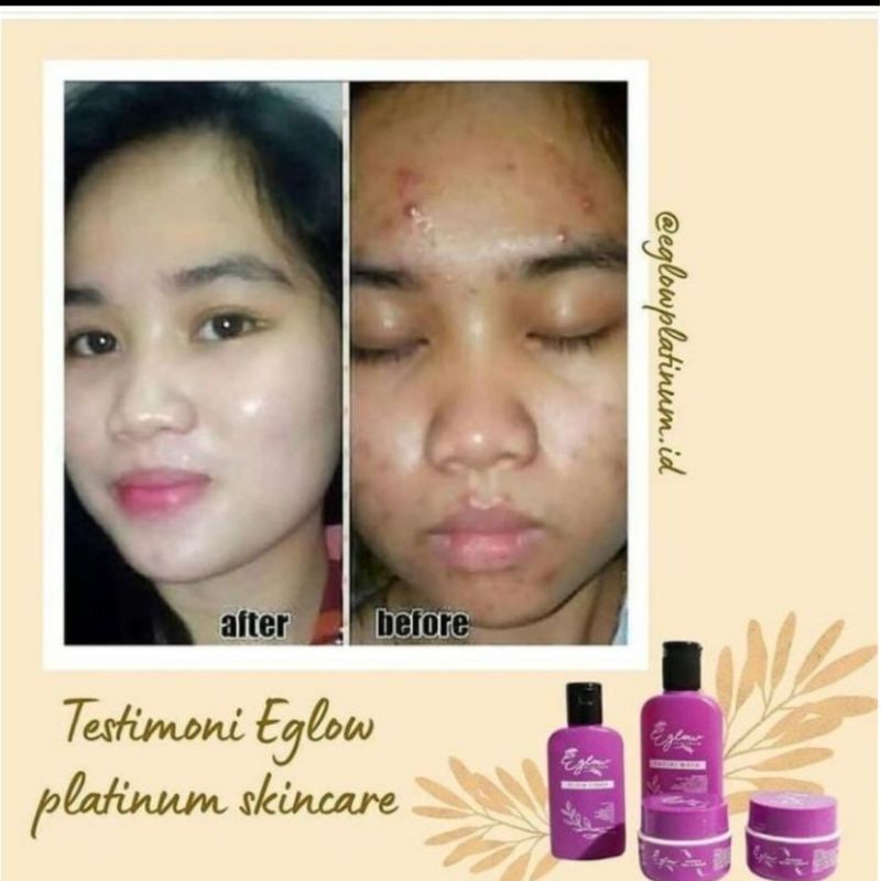 eglow platinum / e glow platinum / cream eglow / eglow whitening / eglow acne / e glow whitening / cream eglow / cream e glow / eglow ultimate / e glow ultimate - cream eglow ultimate - cream e glow ultimate - eglow skincare - e glow skincare