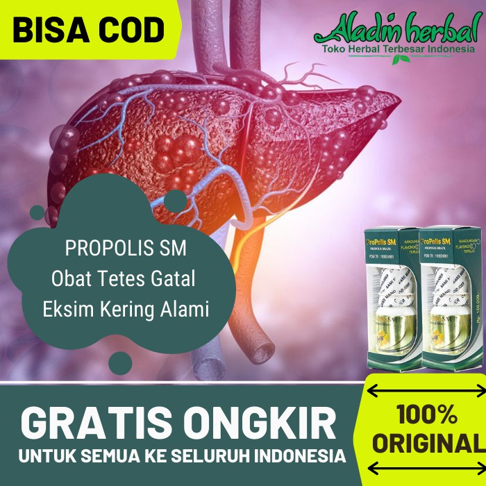 Obat Hepatitis Tradisional - Obat liver bengkak perut, Penyakit kuning, Sirosis dll - Propolis SM