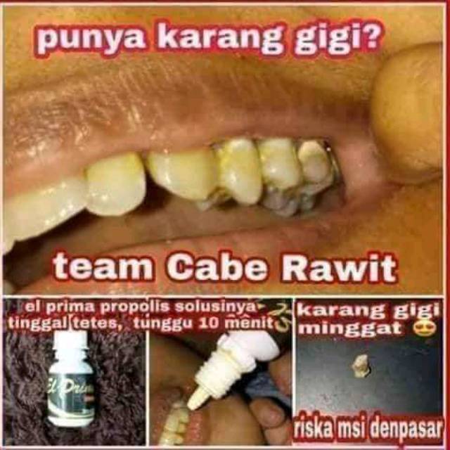 

Propolis obat sakit gigi ,kerontokan karang gigi