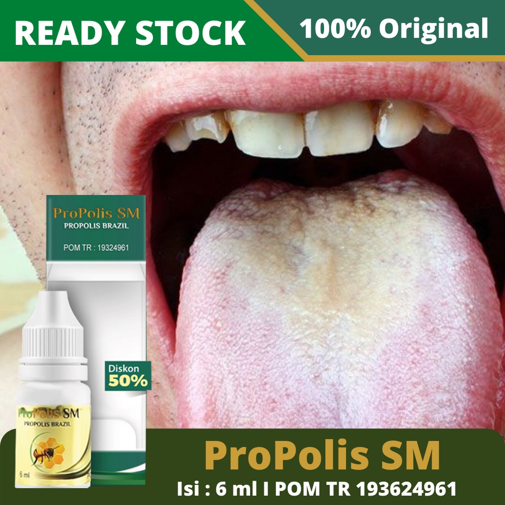 Obat Difreri, Obat Difteri Alami, Obat Radang Lidah, Obat Bercak Putih Dilidah, Obat Difteri Anak Dan Dewasa – ProPolis SM 100% Herbal Alami