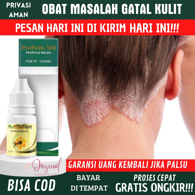 Oba Ketombe berkerak parah bersisik, Obat Jamur kepala, Obat gatal kepala, Obat jamur kulit kepala, 