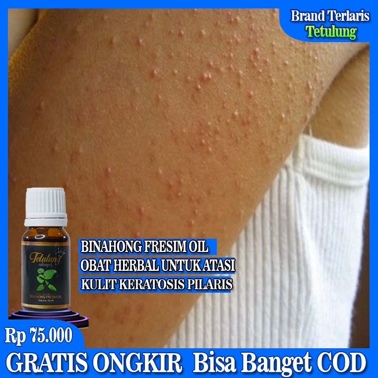 Obat Keratosis Pilaris - Penyakit Kulit Ayam - Kulit Gatal Terasa
